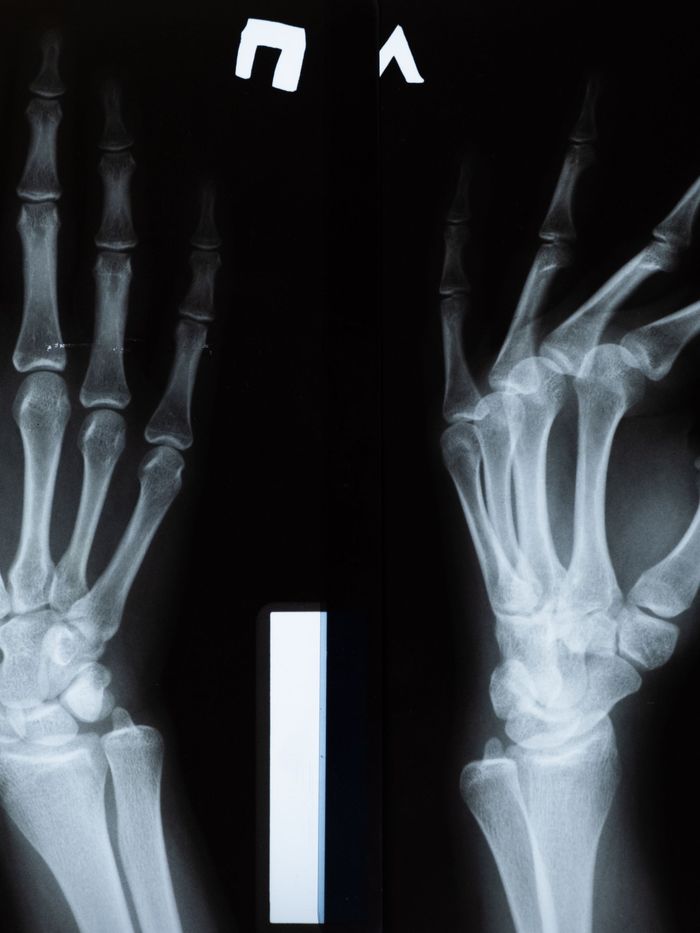 Radiografia de duas mãos sobre fundo preto, com os ossos do punho em destaque.